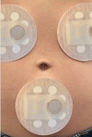 Three patches placed on a person's stomach.